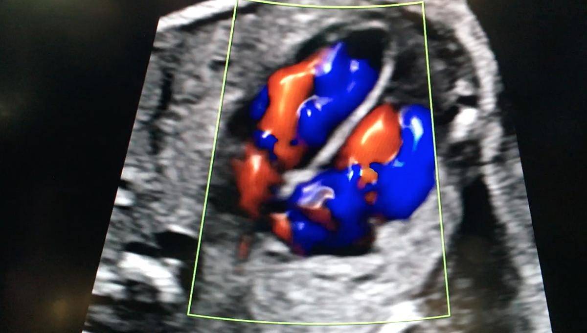 GE Healthcare's fetalHQ heart and vascular analysis software for fetal ultrasound