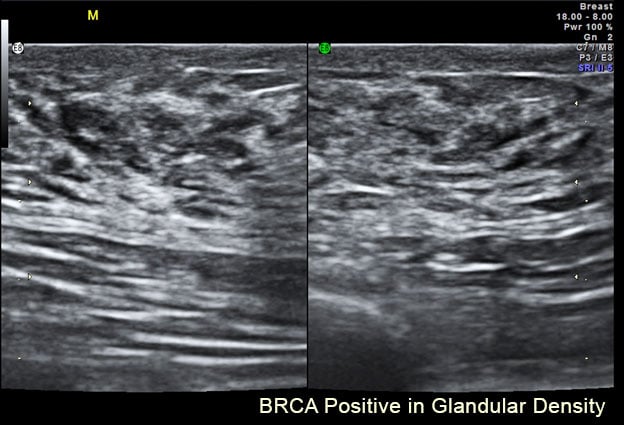 BRCA Positive in Glandular Density