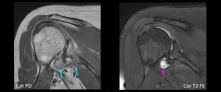 66-year-old female with severe shoulder pain