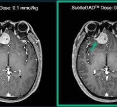 Subtle's AI improves MRI safety exams by reducing gadolinium dose