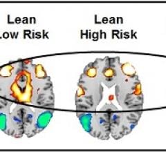 fMRI Study Suggets Childhood Obesity Could Be a Psychological Disorder