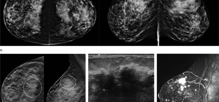 DBT, sometimes called 3-D mammography, emerged in the last decade as a powerful tool for breast cancer screening