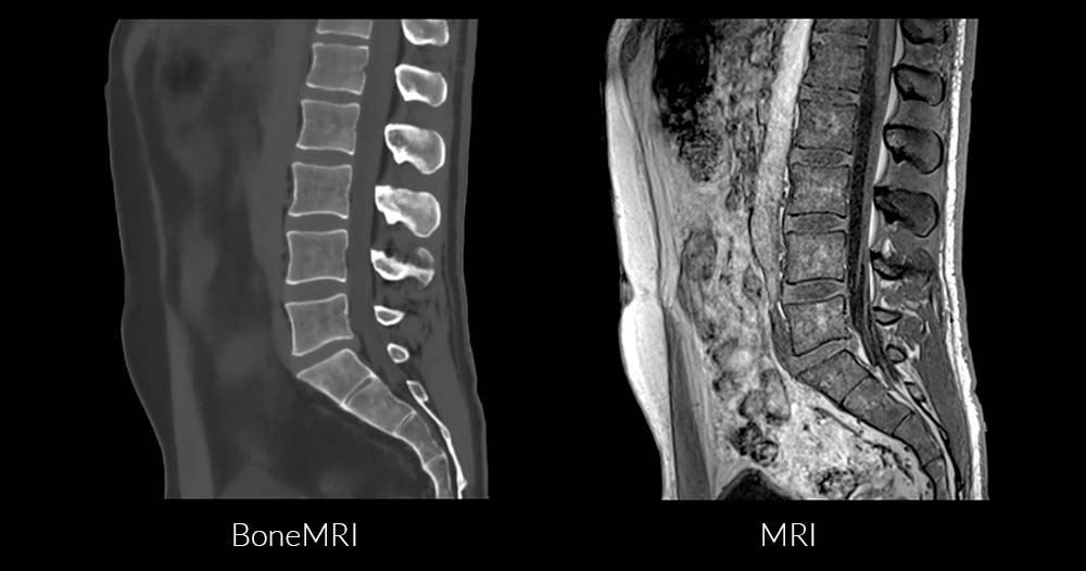 FDA Clears BoneMRI Lumbar Spine for GE Scanners and Cloud