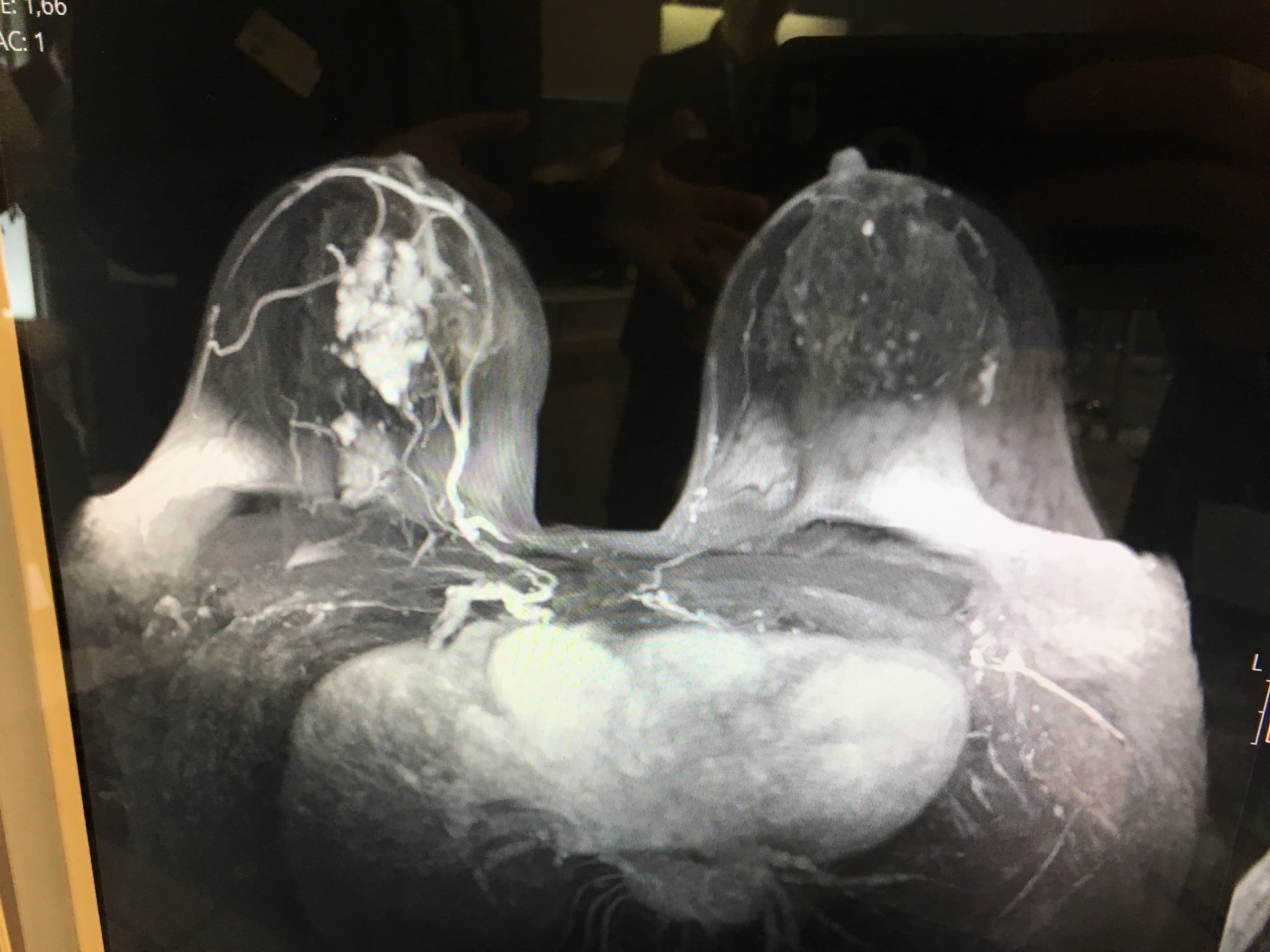 BreastMRI3SectraRSNA18StaffDF_