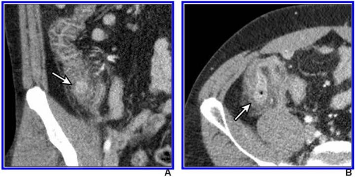 klow rdw appendicitis Diagnosis of Appendicitis in Patients