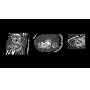 FDA Grants 510(k) Clearance to GE HealthCare's True Definition DL Software