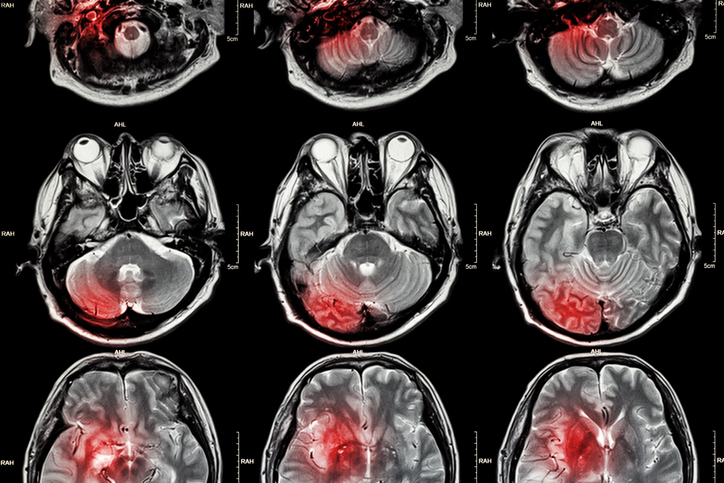 Molecular Targeting Technologies, Inc. Announces New PET Imaging
