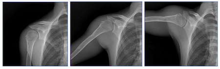 Researchers Use Dynamic Digital Radiography to Quantify Functional Outcomes After Total Shoulder Arthroplasty