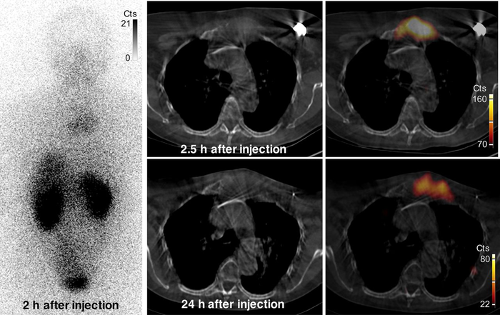 Radiation dose and incidence of new metastasis in the anterior