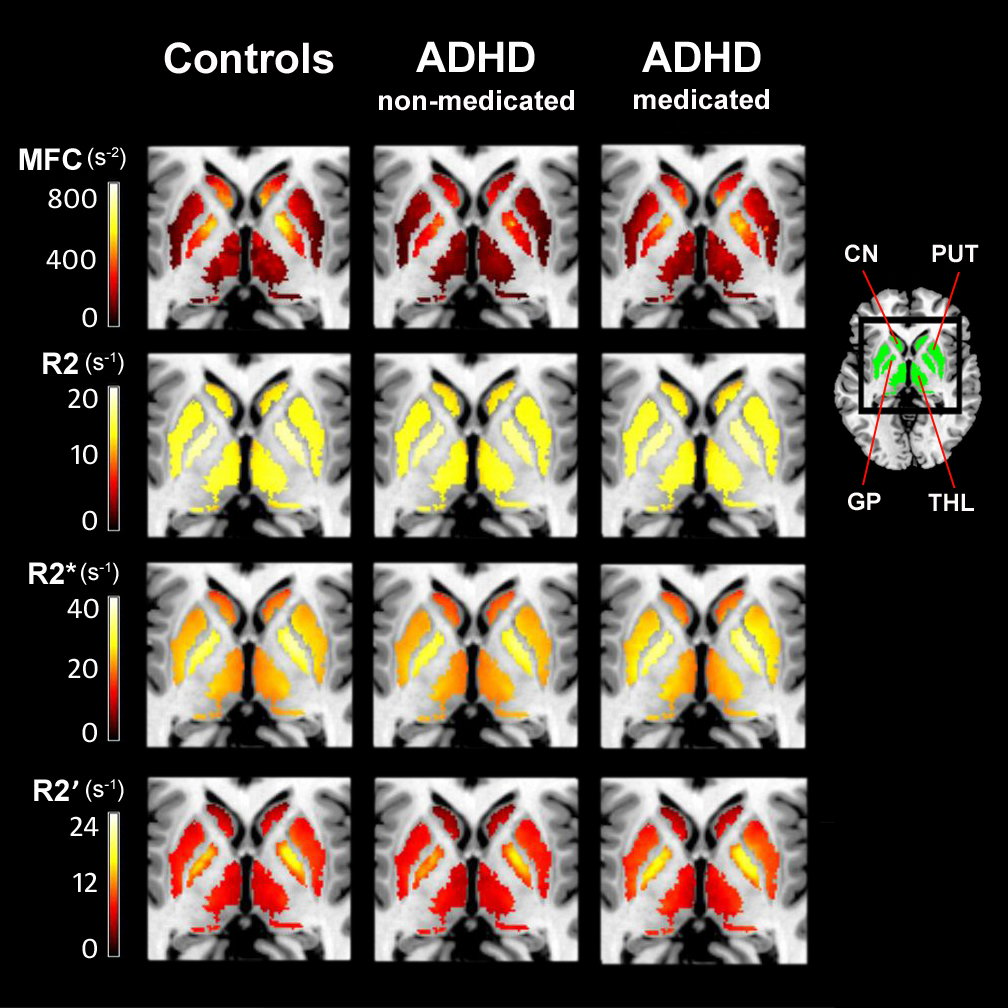 MRI Technique Low Brain Iron in ADHD Patients | Technology News