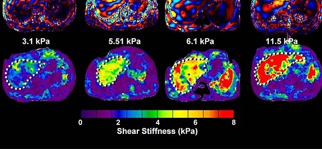 Canon Medical and Resoundant Associate to Present Magnetic Resonance Elastography on Canon MRI Scanners