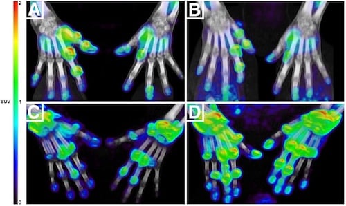 Targeted PET/CT Tracer Helps Rheumatoid Arthritis Patients