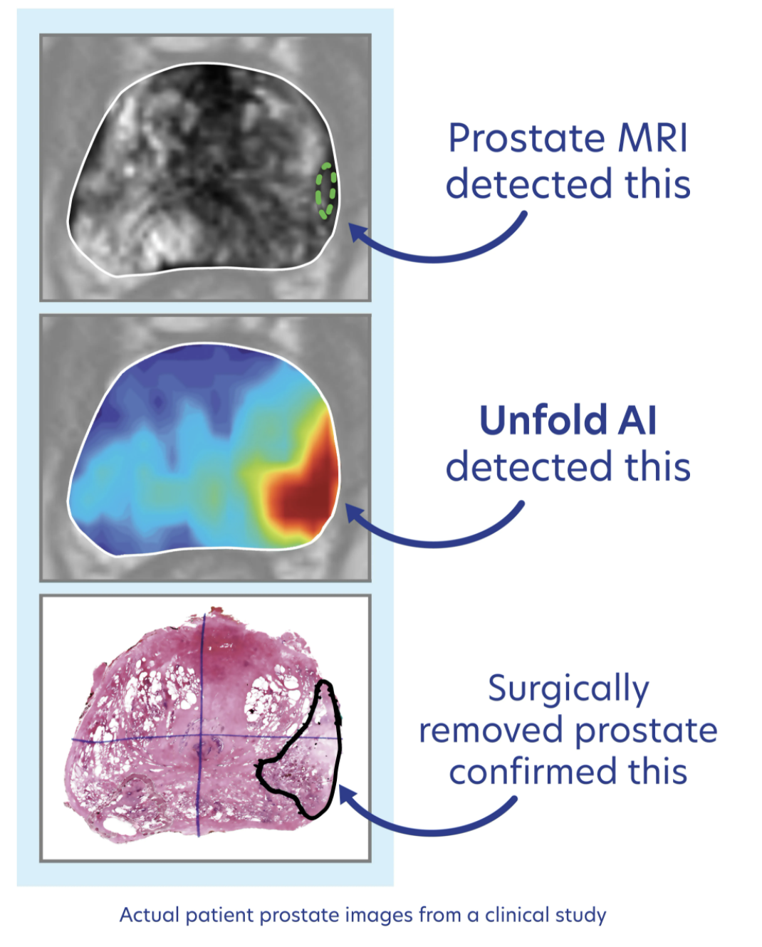 Avenda Health Announces First Commercial Use of Unfold AI on Prostate  Cancer Patients in the US | Imaging Technology News — Credit: Imaging Technology News