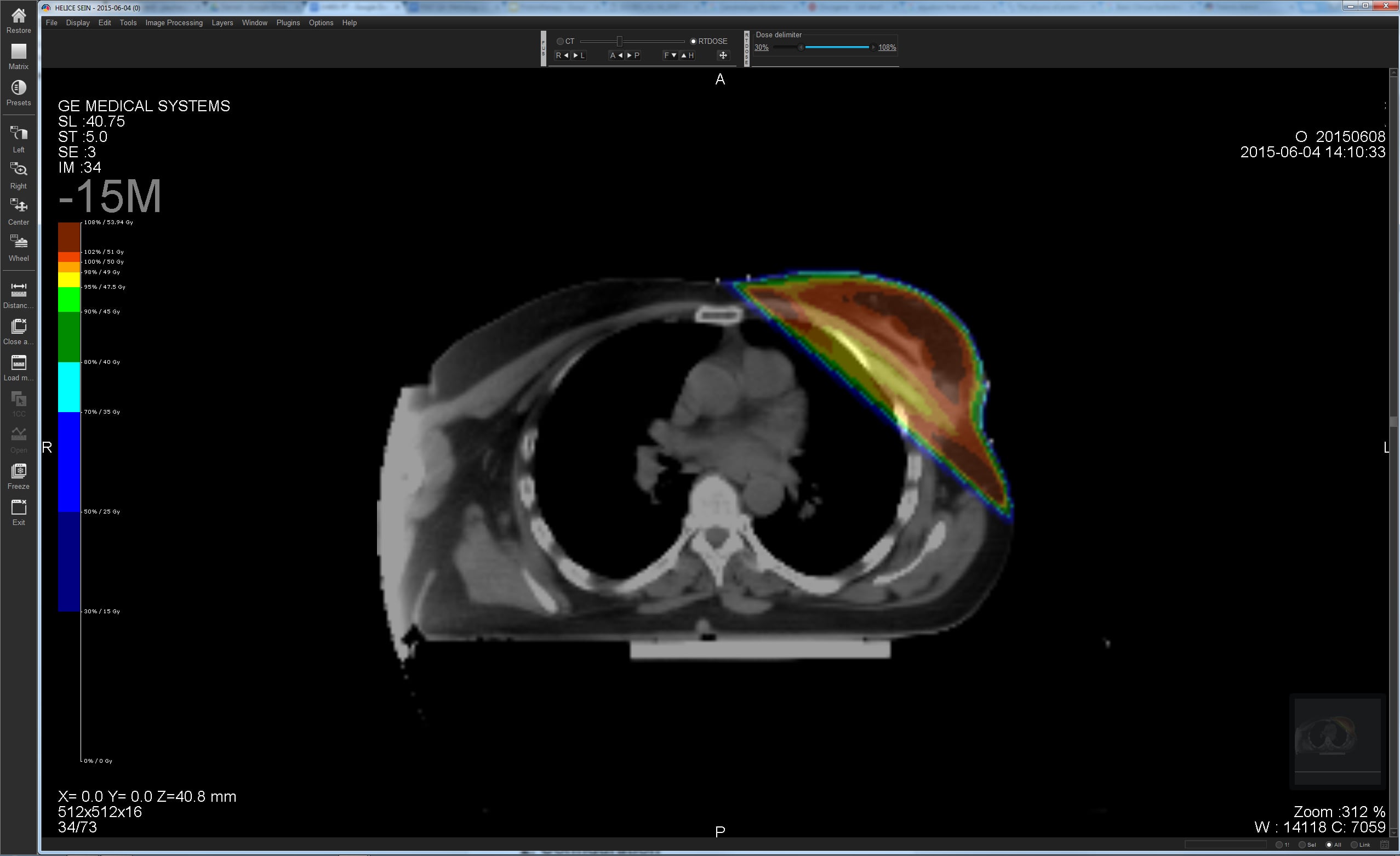 University of Arizona to Develop New CT-Based Breast Cancer