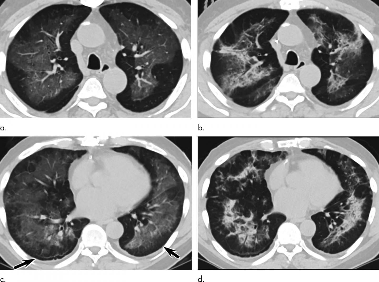 e cigarette induced lung injury Injuries from Vaping Have Characteristic Patterns on CT Pulmonary Injury Resulting from Vaping
