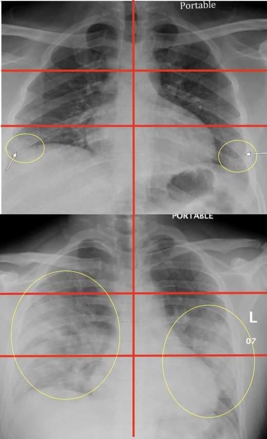Newswise: Chest X-Rays in Emergency Rooms Can Help Predict Severity of COVID-19 Illness in Young and Middle-aged Adults