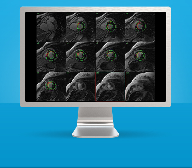 GE Healthcare Introduces New Cardiac MRI Analysis Software