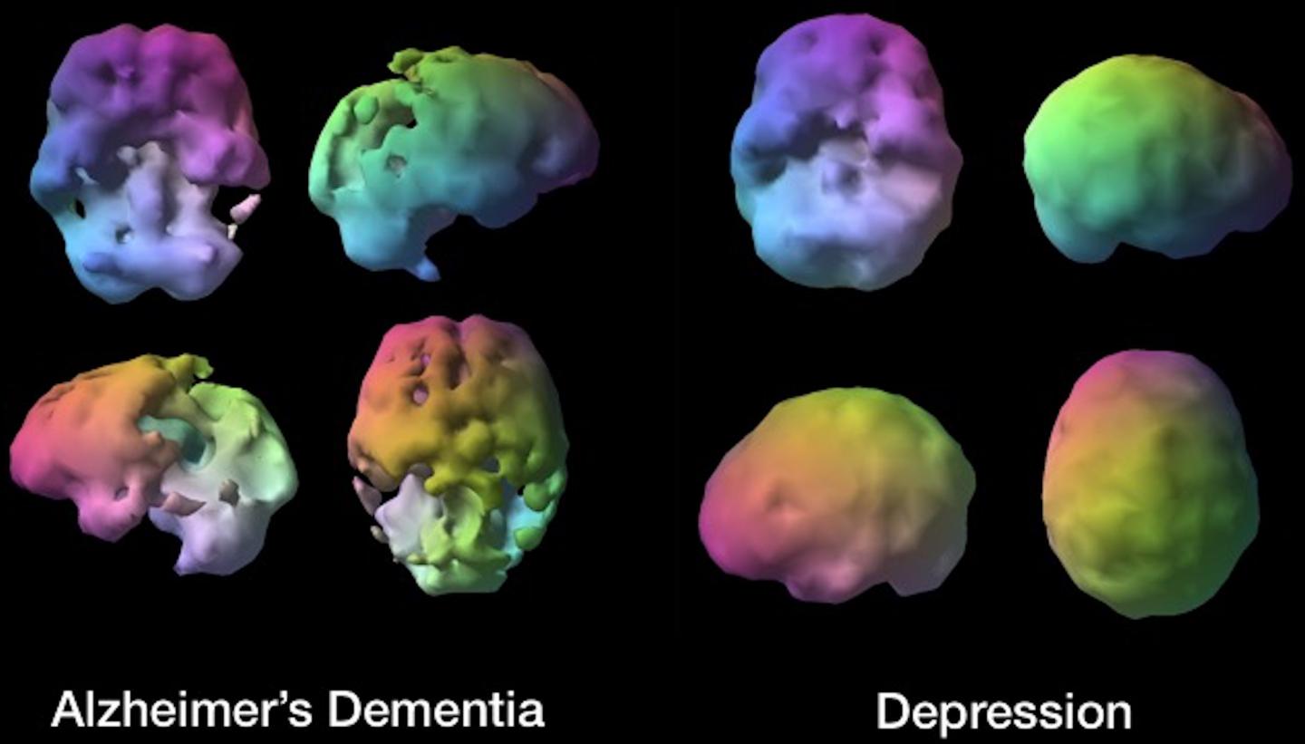 Brain SPECT Imaging Helps Distinguish Dementia From | Imaging Technology News