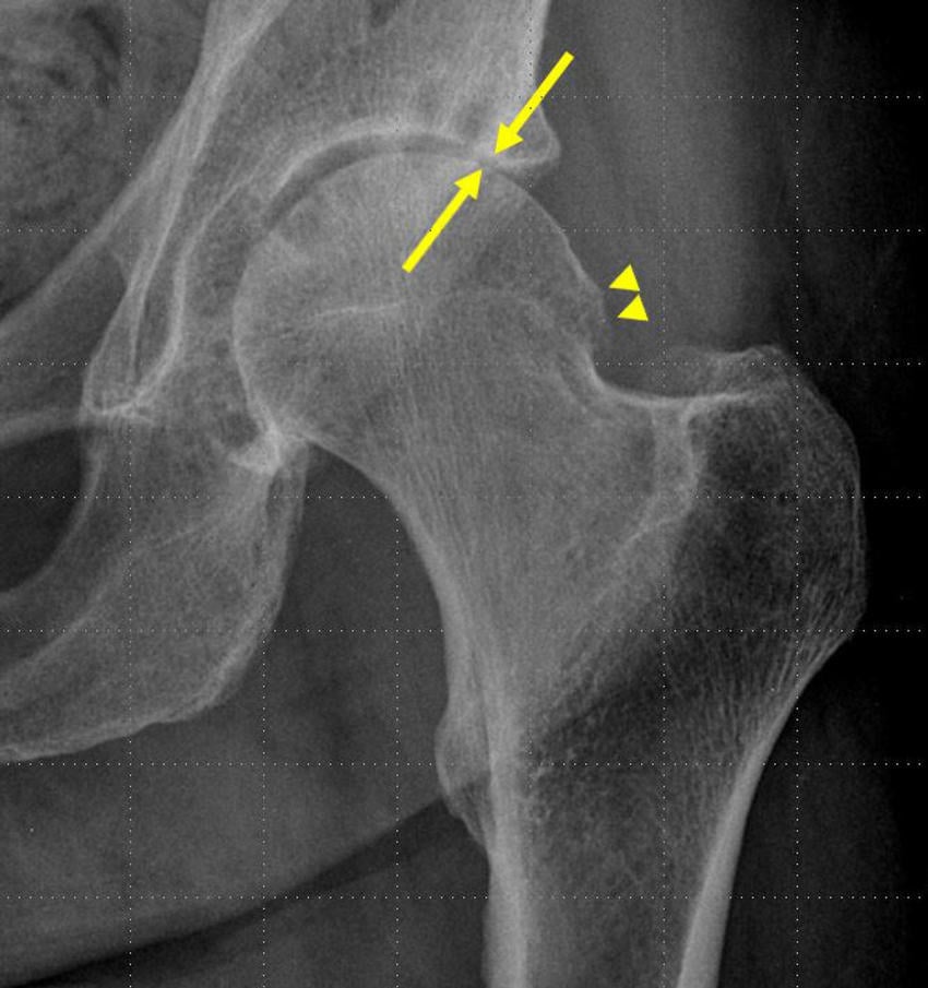 clinical study b12 injection bone spur Hip Steroid Injections Associated With Bone Changes