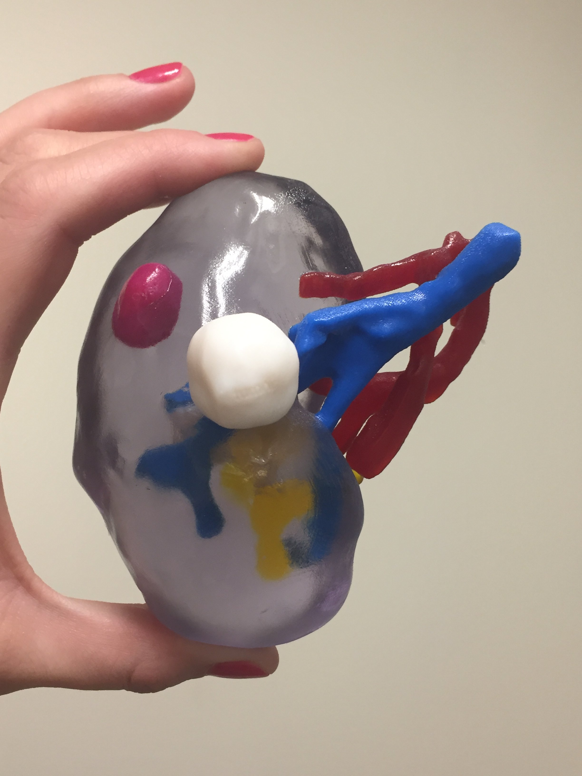 A 3-D printed model (left) and a model constructed in augmented reality (right), both of a kidney with a tumor. In both models, the kidney is clear; the tumor is visible in purple on the AR model and in white on the 3-D printed model.