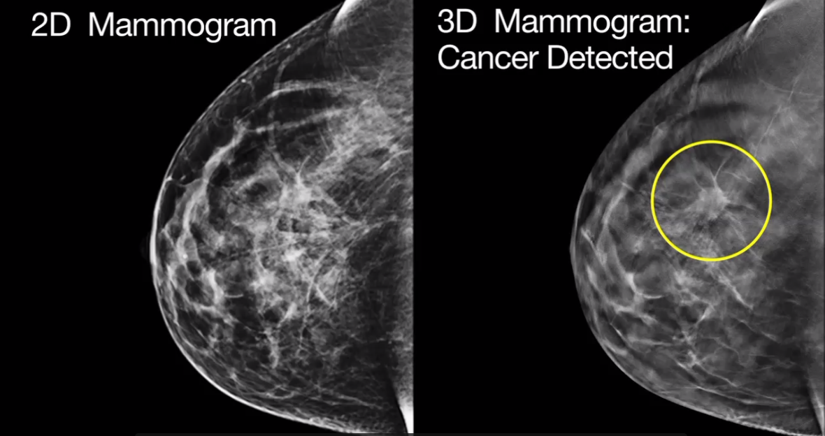 I've been recalled after a mammogram. Have I got breast cancer