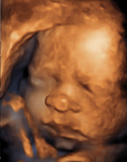 3-D ultrasound, 3D ultrasound, fetal ultrasound