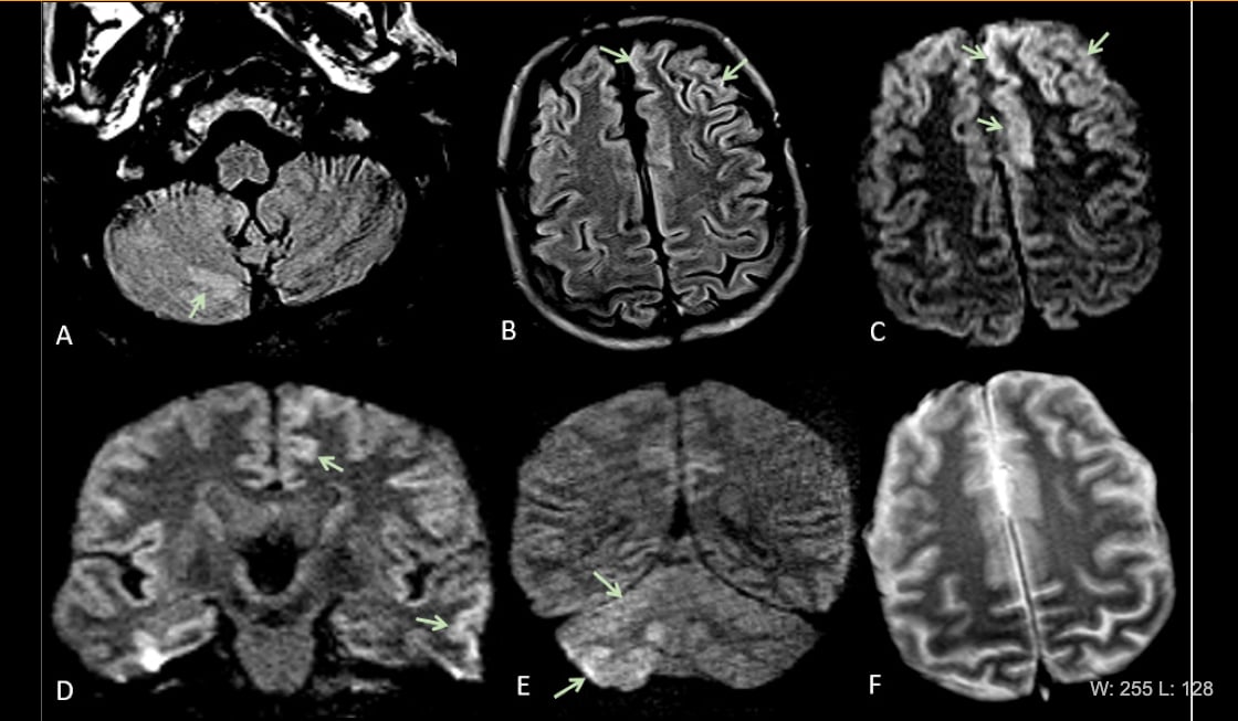 A Prospective Study of Neurologic Disorders in Hospitalized Patients With  COVID-19 in New York City