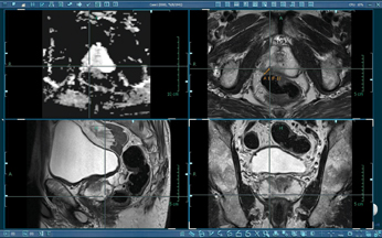 prostate mri radiographics 2022 benign prostatic hyperplasia (bph) causes