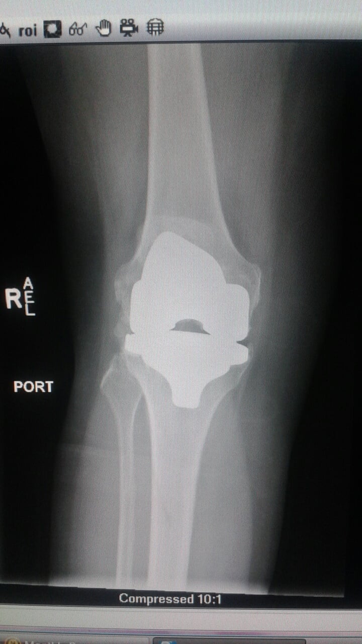 X-ray of a knee replacement. CMS may change reimbursements for joint and knee replacements. Patient Marilyn Fornell.