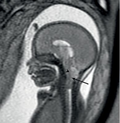 MRI of Fetus, gadolinium contrast may cause harm to fetus