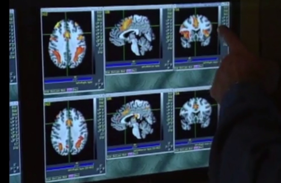 MRI, athlete brain, concussion study, RSNA 2015