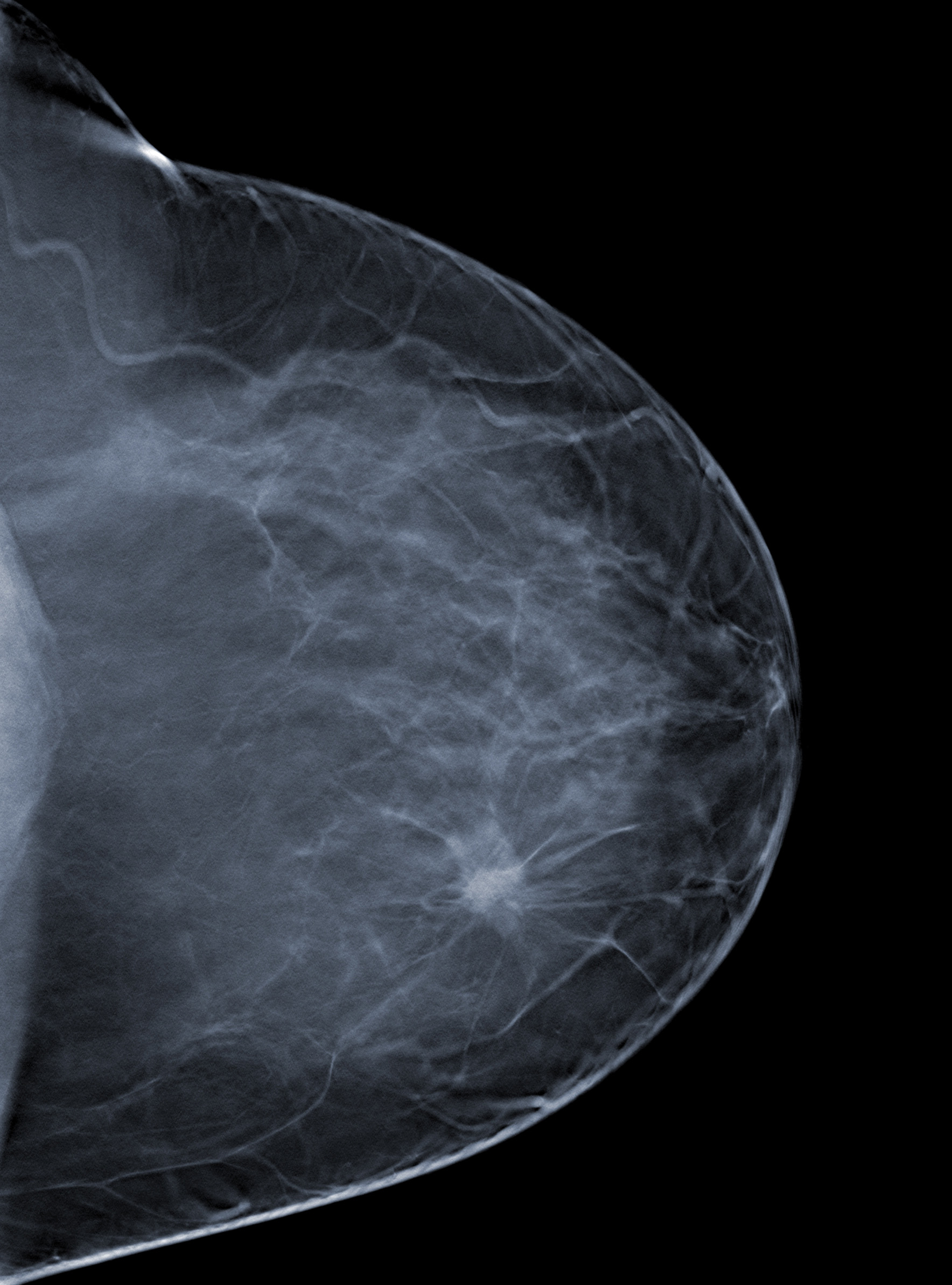 Radiotherapy Mastectomy Women Breast Cancer Lymph Nodes