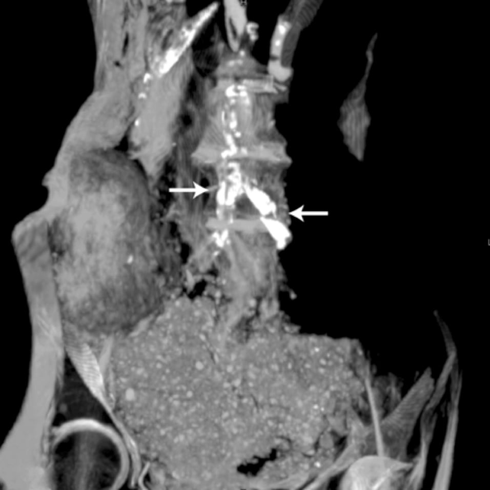 CT scan showing Egyptian mummy with calcified aortic bifurcation.