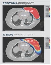 Proton therapy doesn’t get as near to the heart and other internal organs as X-ray therapy does. (Image courtesy of Provision Cares Proton Therapy Center.)