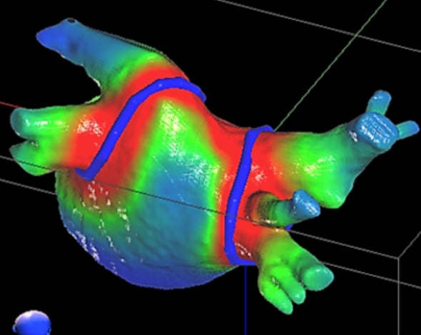 A CyberHeart cardiac ablation radiotherapy treatment plan showing where the radiation beam will ablate for a noninvasive pulmonary vein isolation procedure. Varian acquires, buys, purchases Cyberheart.