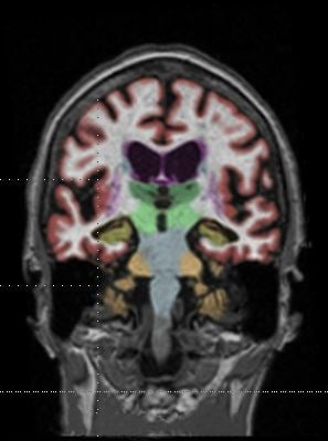 Gadolinium based contrast dye in brain MRI 