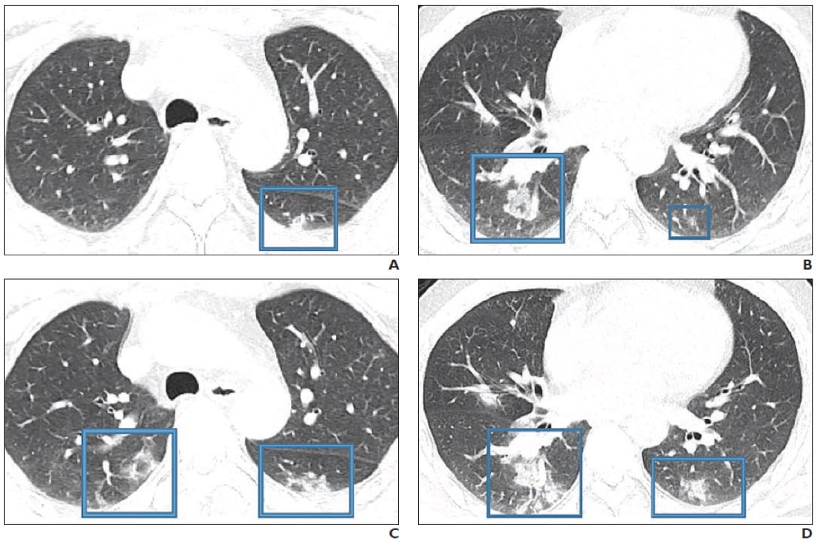 47-year-old Chinese man with 2-day history of fever, chills, productive cough, sneezing, and fatigue who presented to emergency department. A and B, Initial CT images obtained show small round areas of mixed ground-glass opacity and consolidation (rectangles) at level of aortic arch (A) and ventricles (B) in right and left lower lobe posterior zones. C and D, Follow-up CT images obtained 2 days later show progression of abnormalities (rectangles) at level of aortic arch (C) and ventricles (D), which now involve right upper and right and left lower lobe posterior zones. #Coronavirus #COVID19 #2019nCoV