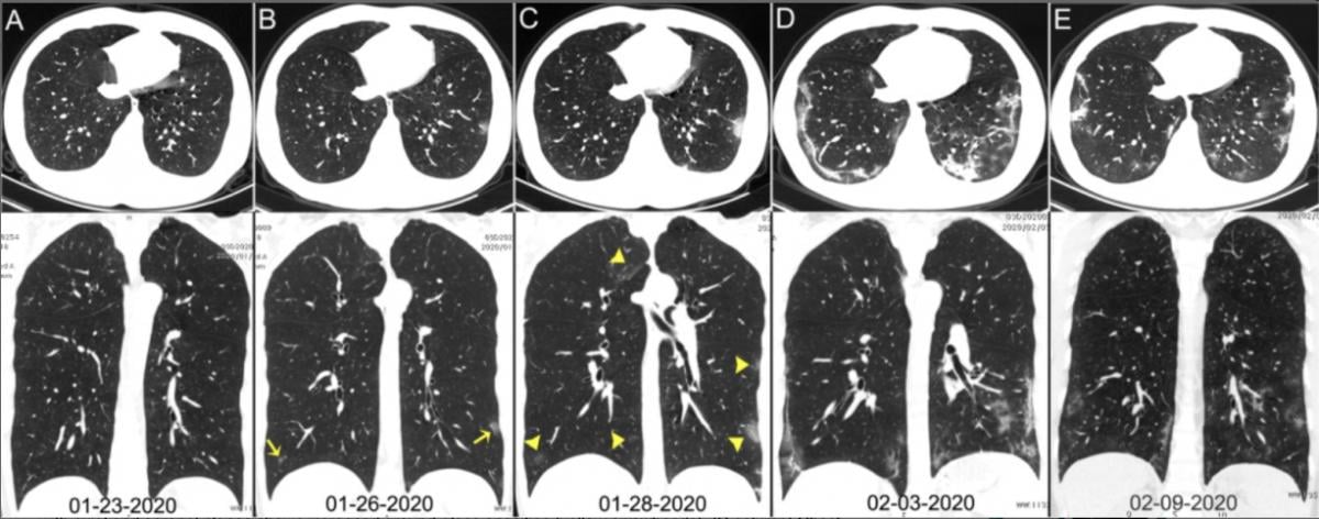 Chest CT images of a 29-year-old man with fever for 6 days. RT-PCR assay for the SARS-CoV-2 using a swab sample was performed on February 5, 2020, with a positive result. (A column) Normal chest CT with axial and coronal planes was obtained at the onset. (B column) Chest CT with axial and coronal planes shows minimal ground-glass opacities in the bilateral lower lung lobes (yellow arrows). (C column) Chest CT with axial and coronal planes shows increased ground-glass opacities (yellow arrowheads). (D column) Chest CT with axial and coronal planes shows the progression of pneumonia with mixed ground-glass opacities and linear opacities in the subpleural area. (E column) Chest CT with axial and coronal planes shows the absorption of both ground-glass opacities and organizing pneumonia. Image courtesy of Radiology. SARS‐CoV‐2