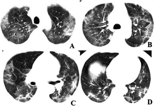 Figure 3: Chest CT imaging of patient 2. A-D, CT images showed multi-focal GGO and mixed consolidation that most appeared at peripheral area of both lungs. The CT involvement score was 11. Image courtesy of Radiology