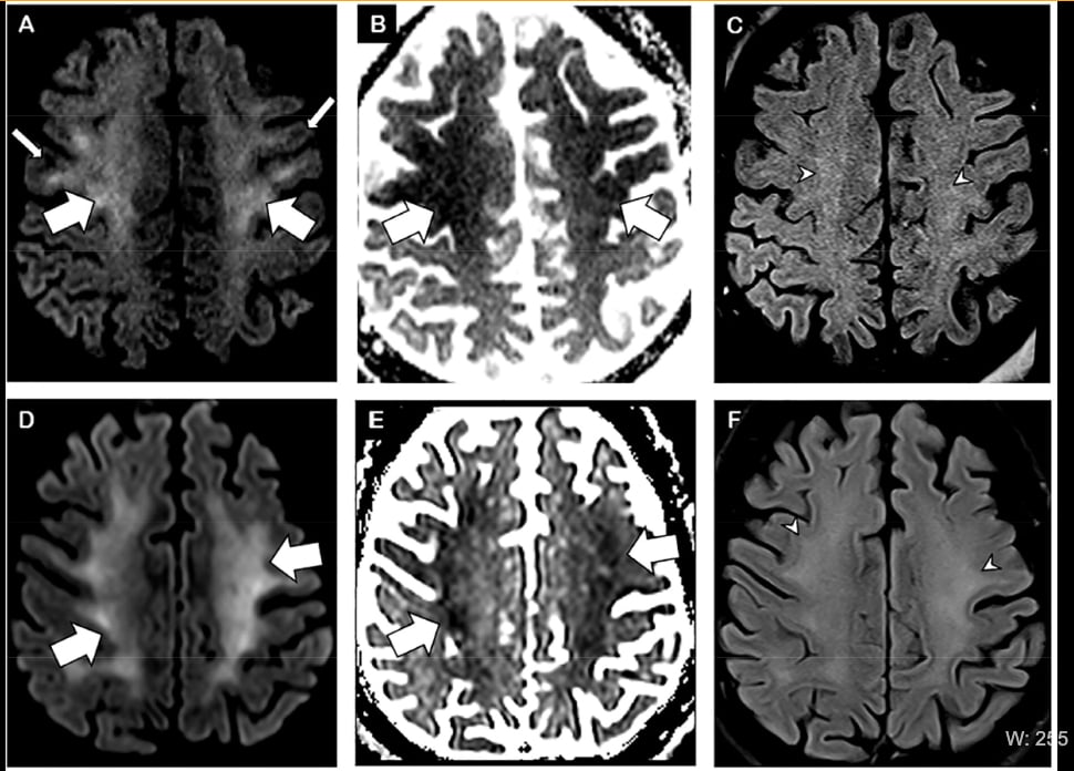 Figure 1. Brain MRI in two critically ill COVID-19 patients with persistently depressed mental status including a 56-year old man (A-C), and a 64-year old man (D-F). Axial diffusion-weighted (A, D), apparent diffusion coefficient (B, E), and FLAIR (C, F) images at the level of centrum semiovale in both patients demonstrate symmetric diffuse T2/FLAIR hyperintensity (arrowheads) and mild restricted diffusion (thick arrows) involving the deep and subcortical white matter with relative sparing of juxtacortical white matter (thin arrows) in both patients. The restricted diffusion is more conspicuous than the T2/FLAIR hyperintensity.  https://pubs.rsna.org/doi/10.1148/radiol.2020202040