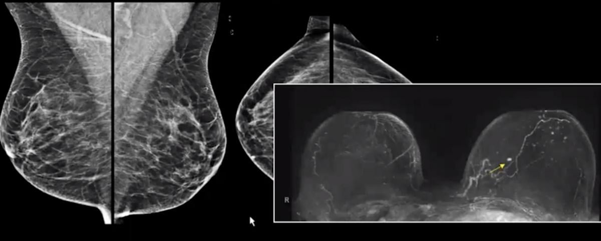Breast MRI showing a clear cancer vs. patient mammogram showing dense breast tissue that masks the cancer.