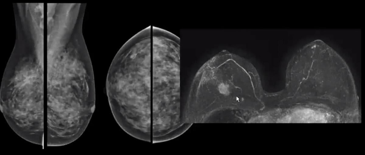 Mammogram vs breast MRI, showing cancers can be masked by dense breast tissue.
