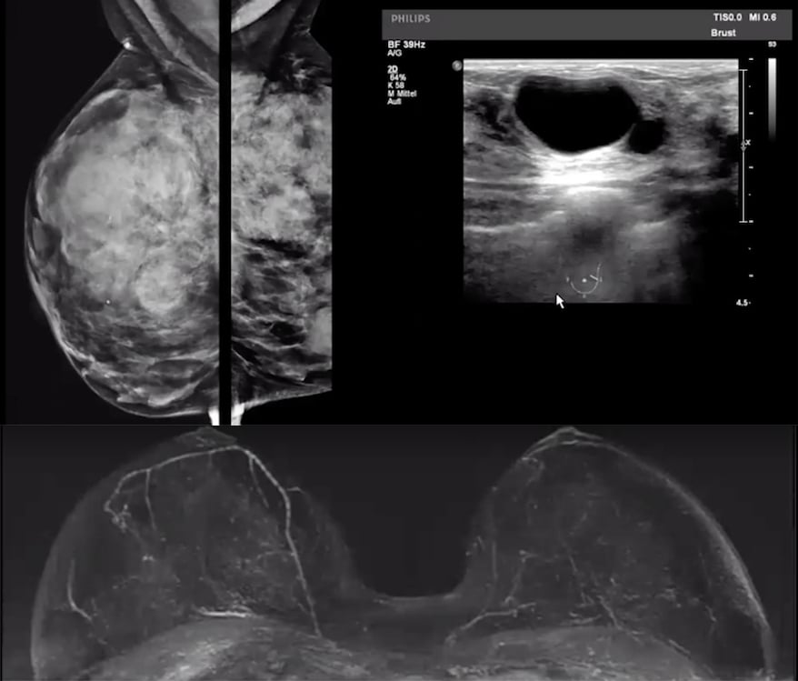 Mammogram of a very dense breast, breast ultrasound and breast MRI showing patient has no cancer.