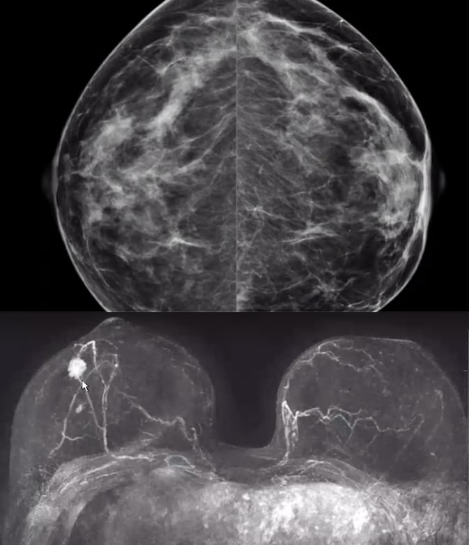 Mammogram versus breast MRI to show a cancer in a patient with very dense breast tissue.