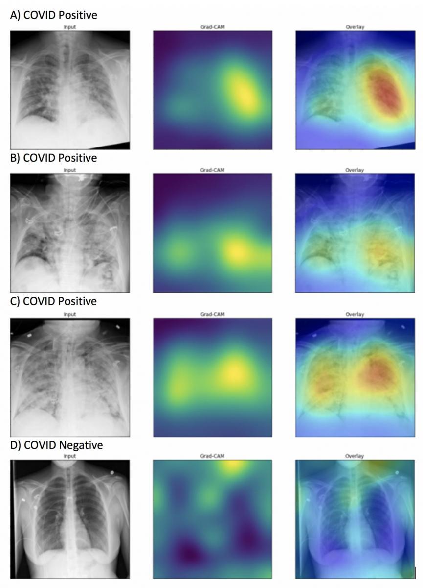 Generated heatmaps appropriately highlighted abnormalities in the lung fields in those images accurately labeled as COVID-19 positive (A-C) in contrast to images which were accurately labeled as negative for COVID-19 (D). Intensity of colors on the heatmap correspond to features of the image that are important for prediction of COVID-19 positivity. Image courtesy of Northwestern University. #RSNA #RSNA20 #RSNA2020