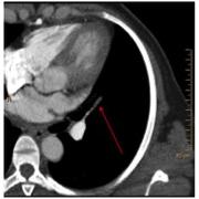 A suspected pulmonary embolism on a conventional CT image is confirmed on a spectral CT by the presence of a corresponding wedge-shaped perfusion defect.