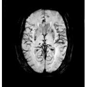 Brain image taken on an Echelon Oval 1.5T MR scanner
