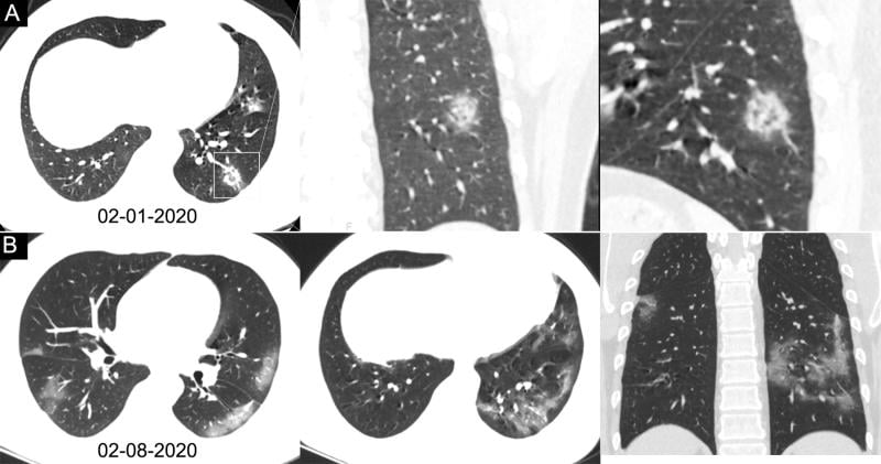 Chest CT images in a 34-year-old man with fever for 4 days. Positive result of reverse-transcription polymerase chain reaction assay for severe acute respiratory syndrome coronavirus 2 using a swab sample was obtained on February 8, 2020. Dates of examination are shown on images. A, Chest CT scan with magnification of lesions in coronal and sagittal planes shows a nodule with reversed halo sign in left lower lobe (box) at the early stage of the pneumonia. B, Chest CT scans in different axial planes