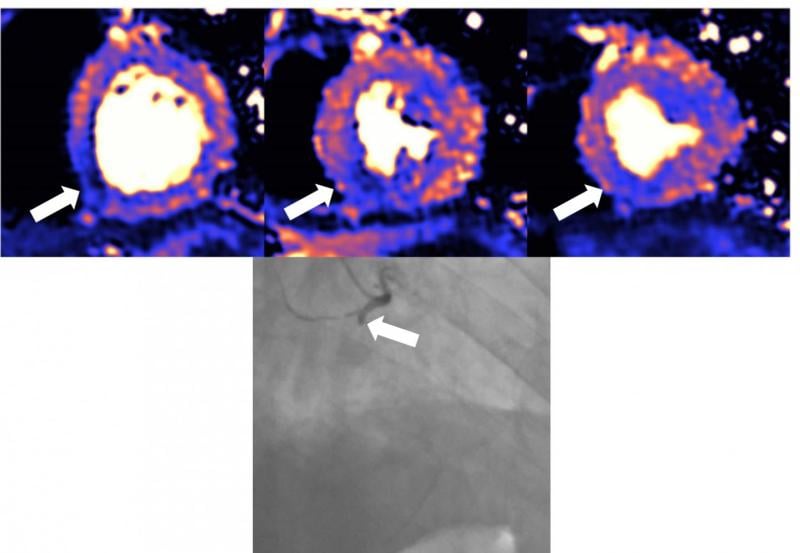 MRI scan of heart damaged by COVID, which can cause myocarditis, infarction and/or ischemia. Blue means reduced blood flow, orange is good blood flow. In this figure the inferior part of the heart shows dark blue, so the myocardial blood flow is very reduced. The angiogram shows the coronary artery which supplies the blood to this part of the heart is occluded. The three colored MRI images show different slices of the heart — the basal mid and apical slices. Read more. Image from European Heart Journal
