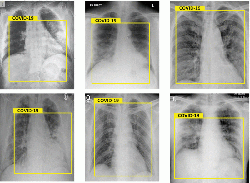 Results of chest X-Rays, detected as Covid-19. Images courtesy of IEEE